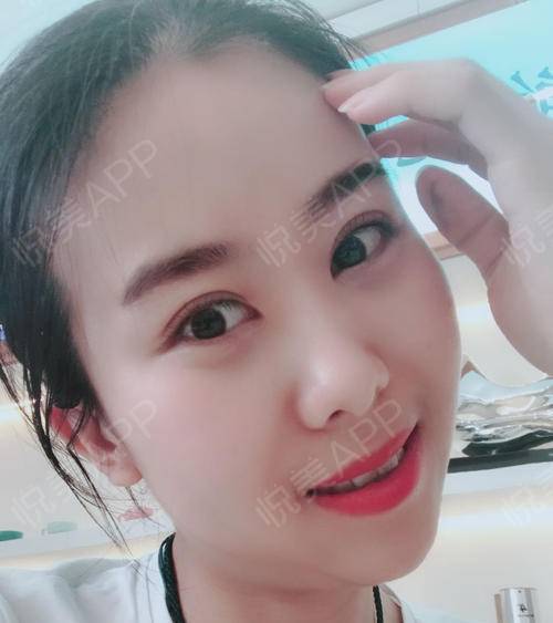 眼睛一點(diǎn)點(diǎn)恢復(fù)，越來越好看 眼部多項(xiàng)手術(shù)的蛻變之旅